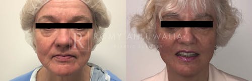 Before & After Result of Facelift Patient #3