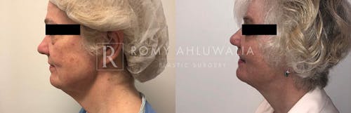 Before & After Result of Facelift Patient #3