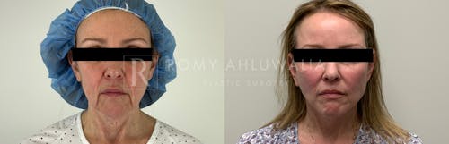 Before & After Result of Facelift Patient #7