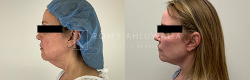 Before & After Result of Facelift Patient #7