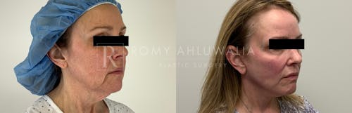Before & After Result of Facelift Patient #7