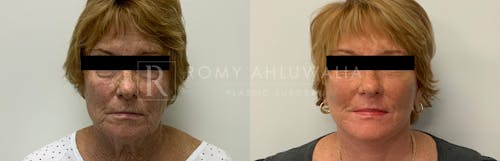 Before & After Result of Facelift Patient #4