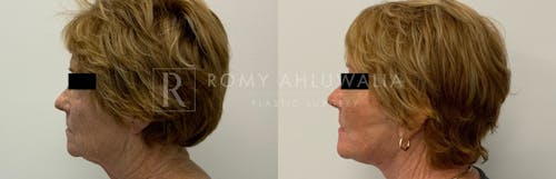 Before & After Result of Facelift Patient #4