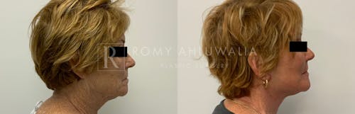 Before & After Result of Facelift Patient #4