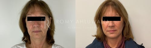 Before & After Result of Facelift Patient #10