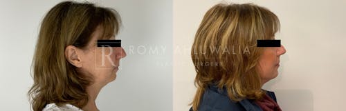 Before & After Result of Facelift Patient #10