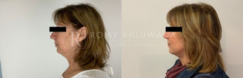 Before & After Result of Facelift Patient #10