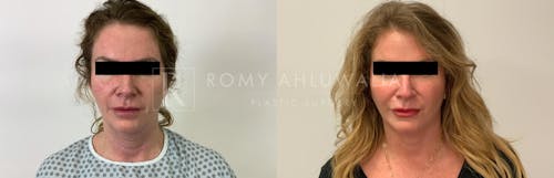 Before & After Result of Facelift Patient #9