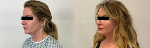 Before & After Result of Facelift Patient #9
