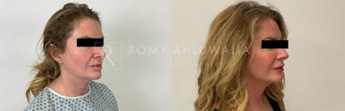 Before & After Result of Facelift Patient #9