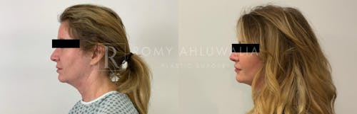 Before & After Result of Facelift Patient #9