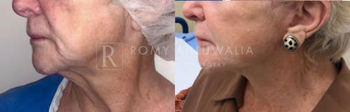 Before & After Result of Facelift Patient #13