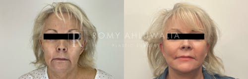 Before & After Result of Facelift Patient #2