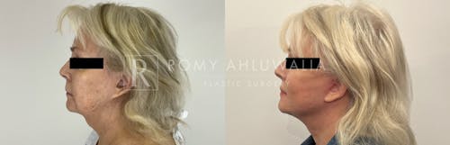 Before & After Result of Facelift Patient #2
