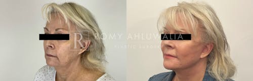 Before & After Result of Facelift Patient #2