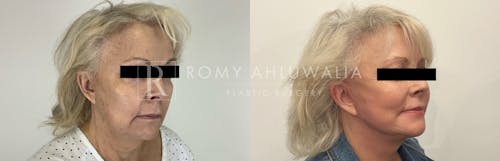 Before & After Result of Facelift Patient #2