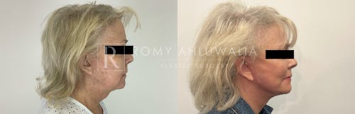 Before & After Result of Facelift Patient #2