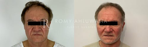 Before & After Result of Facelift Patient #11