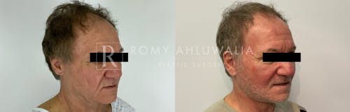 Before & After Result of Facelift Patient #11