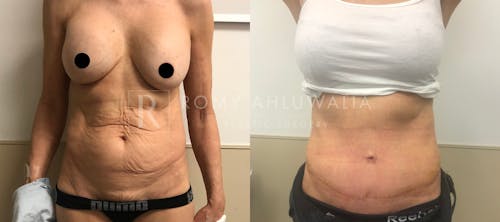 Before & After Result of Tummy Tuck Patient #8