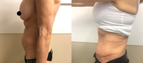 Before & After Result of Tummy Tuck Patient #8