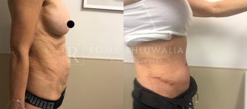 Before & After Result of Tummy Tuck Patient #8
