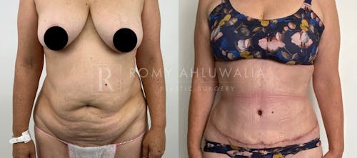 Before & After Result of Tummy Tuck Patient #9