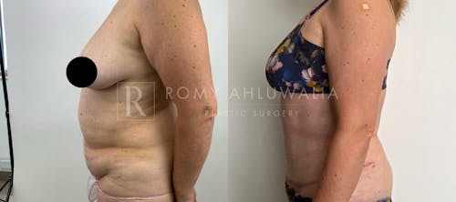 Before & After Result of Tummy Tuck Patient #9