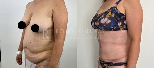 Before & After Result of Tummy Tuck Patient #9