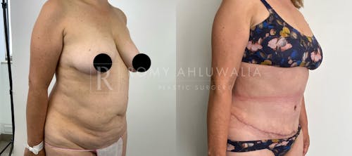 Before & After Result of Tummy Tuck Patient #9