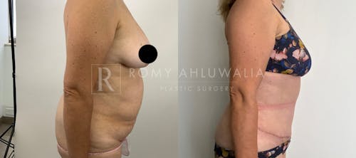 Before & After Result of Tummy Tuck Patient #9