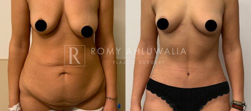 Before & After Result of Tummy Tuck Patient #6