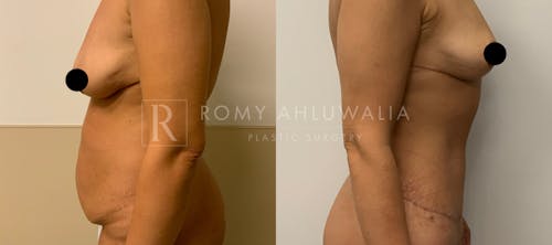 Before & After Result of Tummy Tuck Patient #6