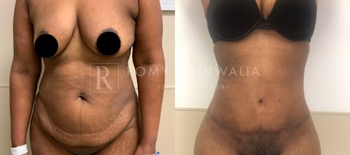 Before & After Result of Tummy Tuck Patient #10