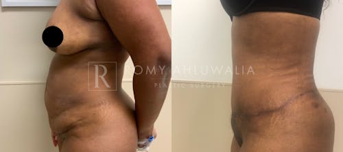Before & After Result of Tummy Tuck Patient #10