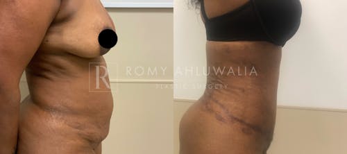 Before & After Result of Tummy Tuck Patient #10