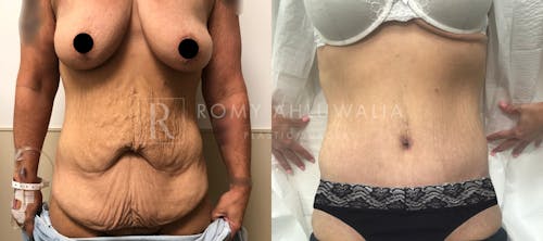 Before & After Result of Tummy Tuck Patient #11