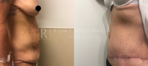 Before & After Result of Tummy Tuck Patient #11