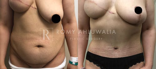 Before & After Result of Tummy Tuck Patient #12