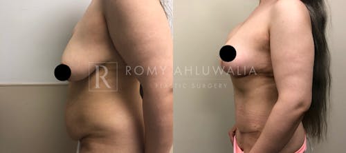 Before & After Result of Tummy Tuck Patient #12