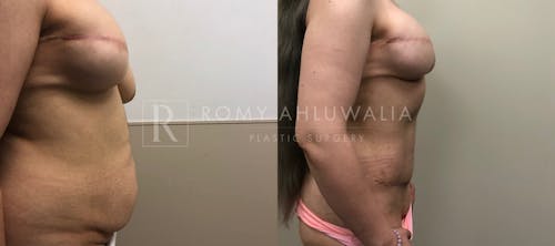 Before & After Result of Tummy Tuck Patient #12