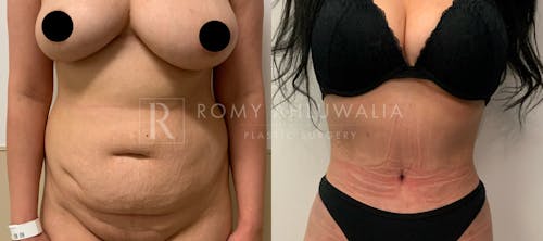 Before & After Result of Tummy Tuck Patient #3