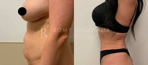Before & After Result of Tummy Tuck Patient #3