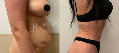 Before & After Result of Tummy Tuck Patient #3