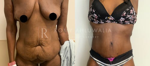Before & After Result of Tummy Tuck Patient #13