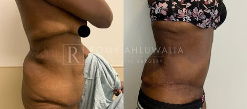 Before & After Result of Tummy Tuck Patient #13