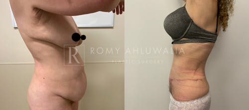 Before & After Result of Tummy Tuck Patient #14