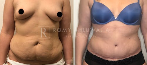 Before & After Result of Tummy Tuck Patient #15