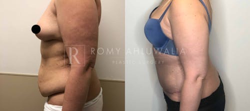 Before & After Result of Tummy Tuck Patient #15