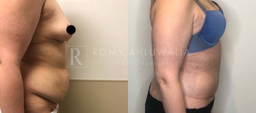 Before & After Result of Tummy Tuck Patient #15
